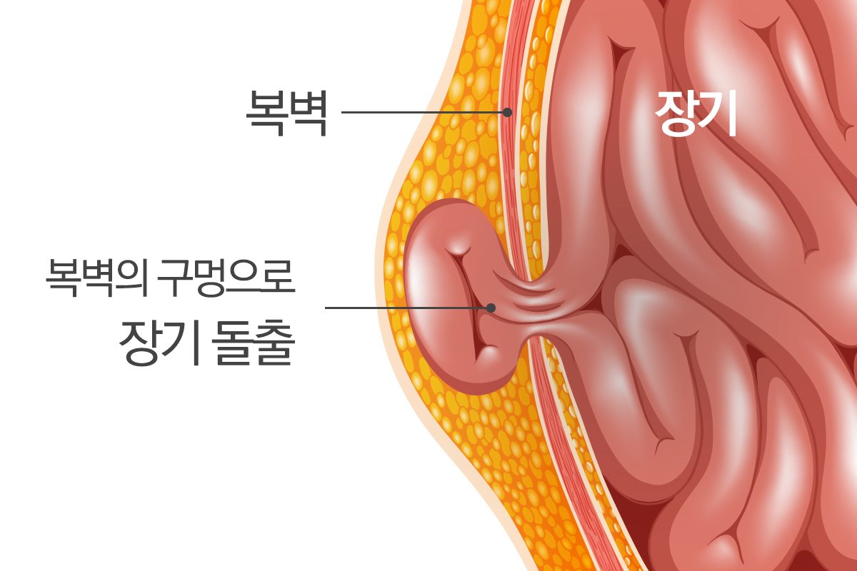 '미우새'김종국.탈장진단! 장기튀어나오면 손으로 눌러... 썸네일이미지